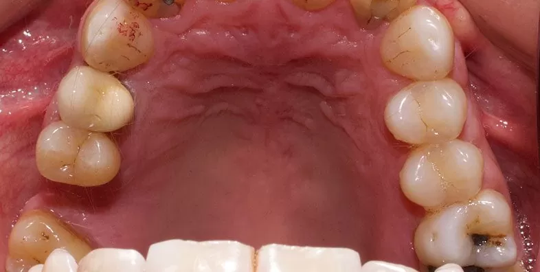 After-Dental-Implant-at-EDC.jpg