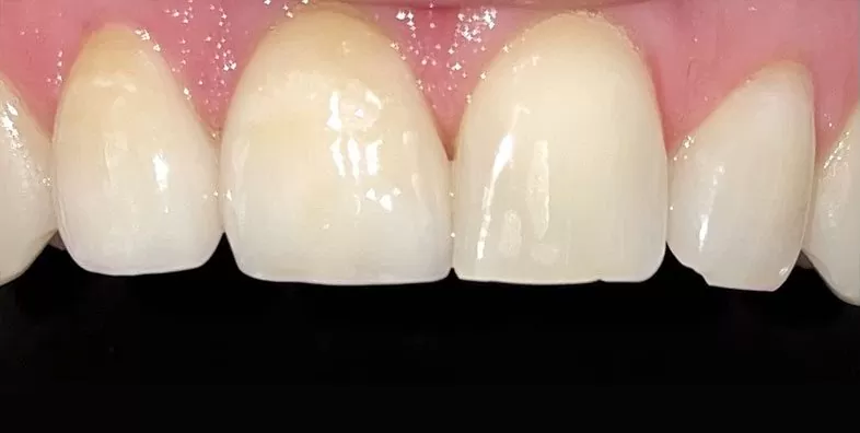 After-Porcelain-Veneer-Treatment.jpg