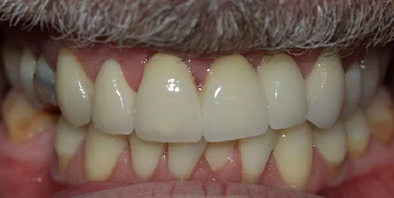 After-crown-bridge-treatment.jpg