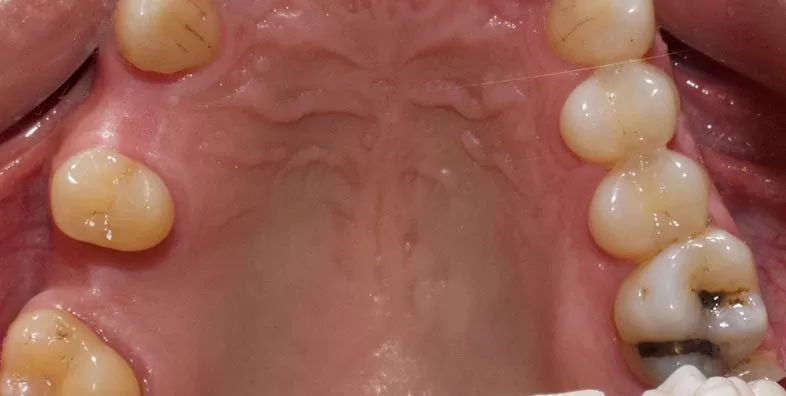 Before-Dental-Implant-at-EDC.jpg