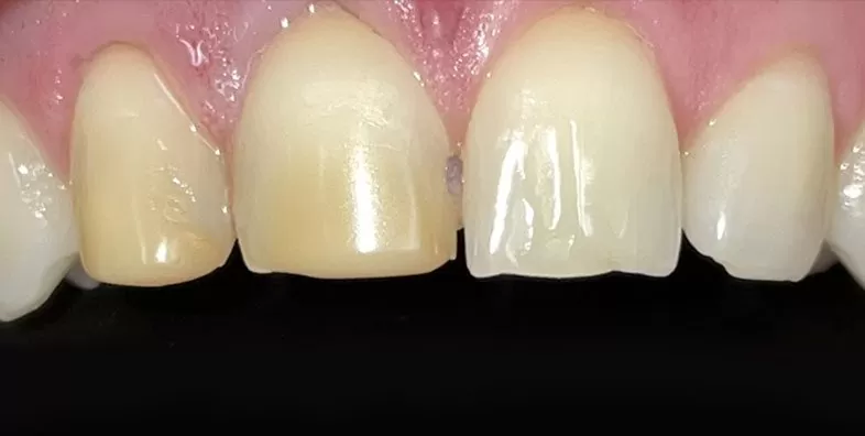 Before-Porcelain-Veneer-Treatment.jpg
