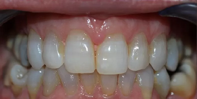 Clear-aligners-after-treatment.jpg