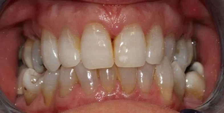 Clear-aligners-before-treatment.jpg