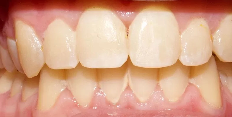 Closed-bite-After.jpg