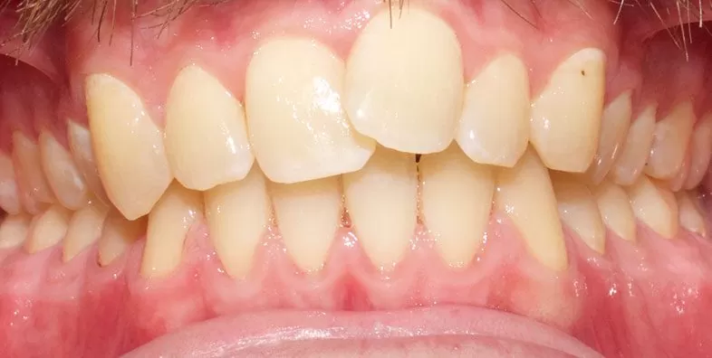 Closed-bite-BEFORE.jpg