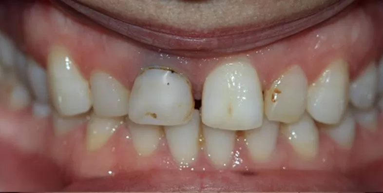 Crown-before-treatment.jpg