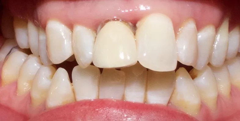 Intraoral-BEFORE.jpg