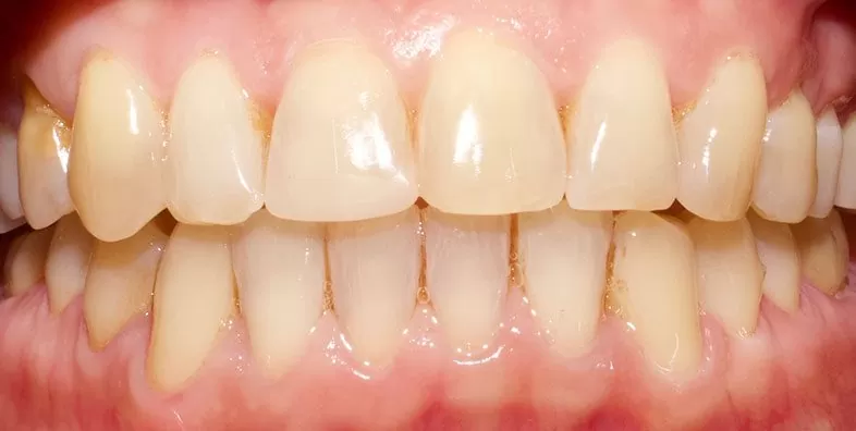 Invisalign-After-treatment.jpg