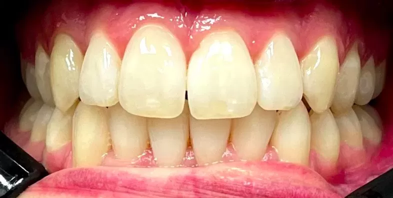 Invisalign-After.jpg