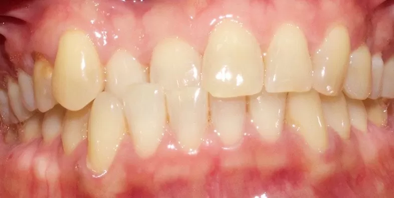 Invisalign-Before-treatment.jpg
