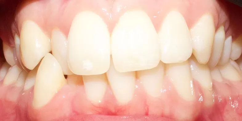 Invisalign-Before.jpg