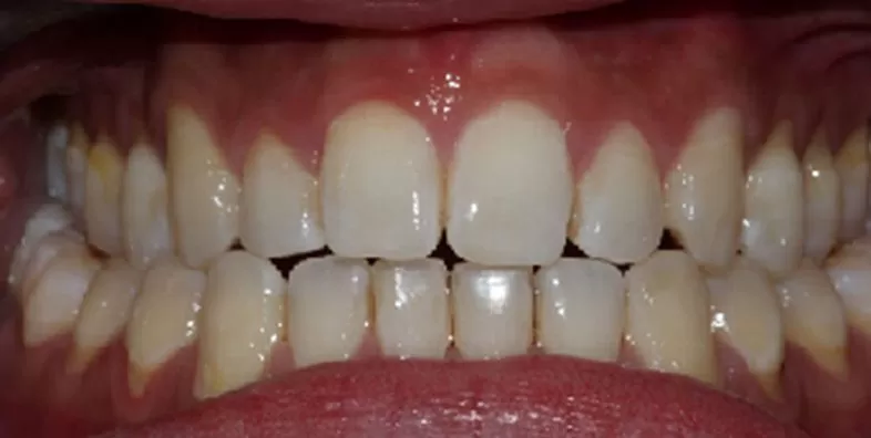 Invisalign-Clear-aligners-after-treatment.jpg