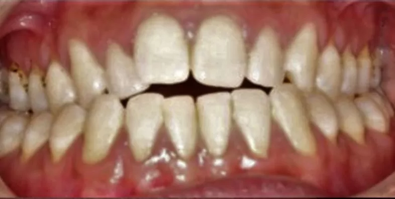 Invisalign-Clear-aligners-before-treatment.jpg