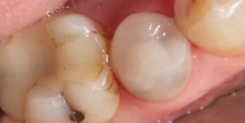 OVC-After-premolar.jpg