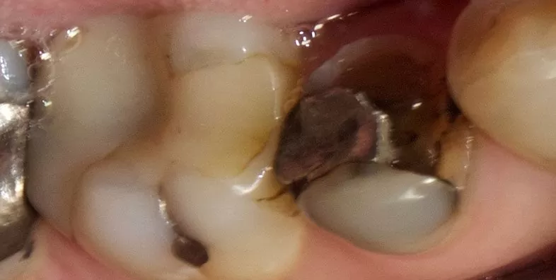 OVC-before-premolar.jpg