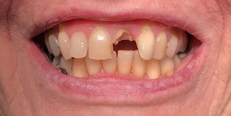 Pre-op-Smile.jpg