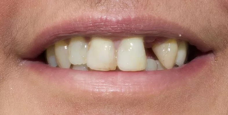 Smile-Pre-op.jpg