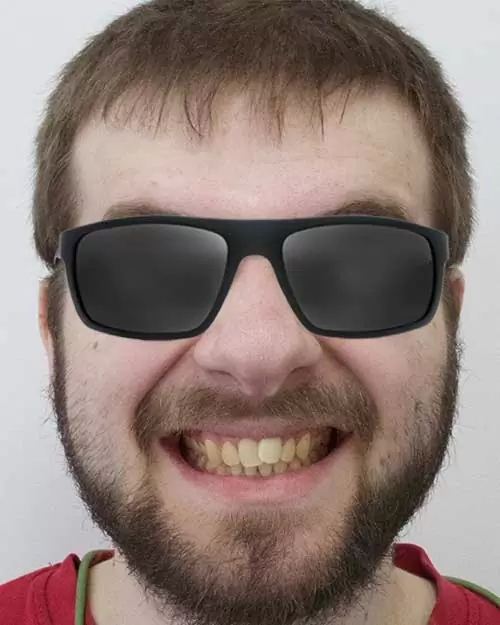 Smile-before-treatment-.jpg