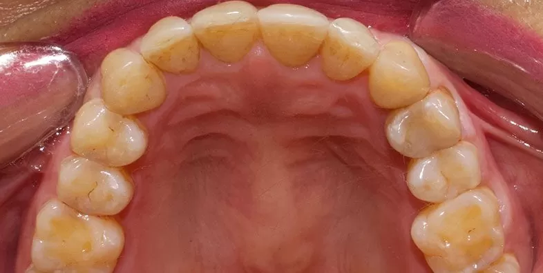 Upper-occlusal-AFTER.jpg