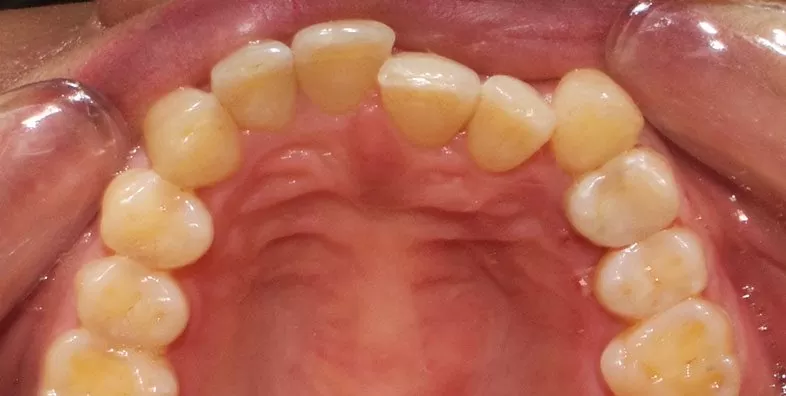 Upper-occlusal-BEFORE.jpg