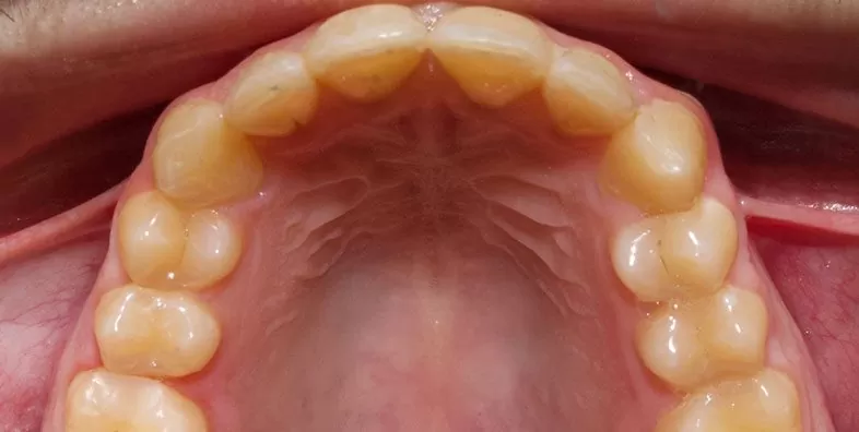 Upper-occlusal-after-1.jpg