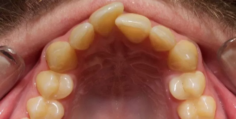 Upper-occlusal-before-1.jpg