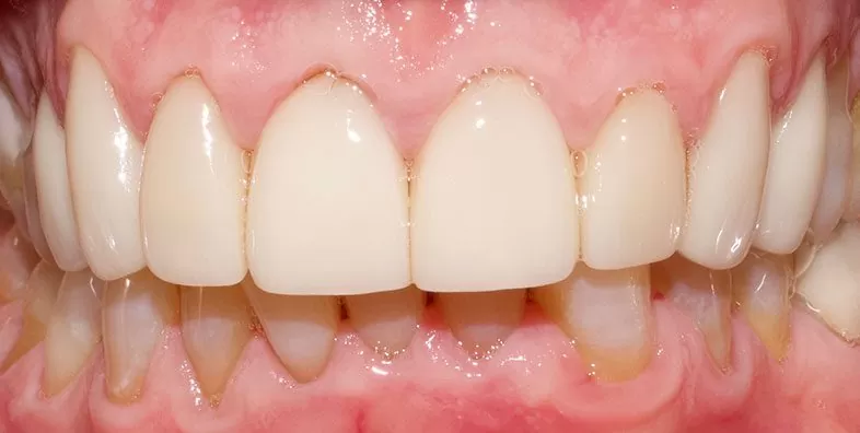 Veneers-after.jpg