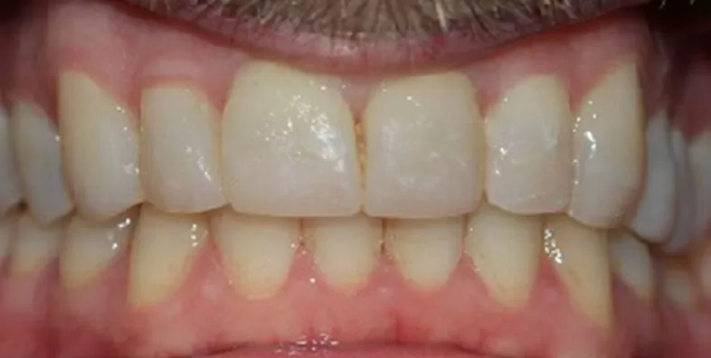 composite-buildups-after-treatment.jpg