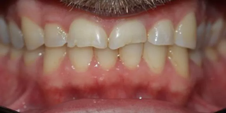 composite-buildups-before-treatment.jpg